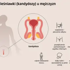 Objawy kandydozy u mężczyzn: swędzenie, ból, spadek libido. Domowe leczenie grzybicy prącia może pomóc.