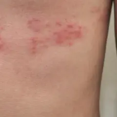 Czerwone plamy na ciele, skupione w klastry, sugerują wysypkę.