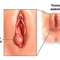 Powiększony gruczoł Bartholina po lewej, po prawej normalna anatomia.