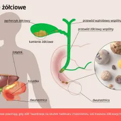 Anatomia człowieka z zaznaczonym pęcherzykiem żółciowym i kamieniami żółciowymi. Obok zdjęcie kamieni.
