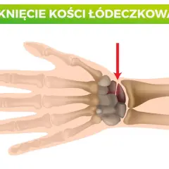 Złamana kość łódeczkowata nadgarstka, zaznaczona czerwoną strzałką.