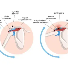 Anatomia barku: prawidłowe położenie ścięgna mięśnia nadgrzebieniowego i kaletki podbarkowej w porównaniu do ucisku i bólu. Obojczyk jest częścią obręczy barkowej.