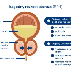 Ilustracja przedstawia łagodny rozrost stercza (BPH), powiększony gruczoł uciskający cewkę moczową, powodując objawy podrażnienia i obturacji.