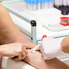 Pobieranie krwi do badań. Pacjentka ma lekko widoczne żyły, co ułatwia procedurę. Wyniki badań MPV niskie mogą wskazywać na pewne schorzenia.