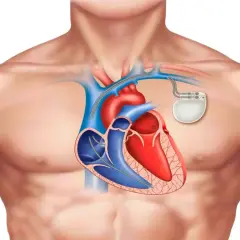 Anatomical illustration of a human chest showing a heart with a rozrusznik serca implanted.