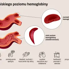 Porównanie krwinek: normalny poziom hemoglobiny vs. niski poziom hemoglobiny (niedokrwistość). Objawy niskiego poziomu hemoglobiny: ból głowy, bladość, zmęczenie.