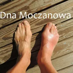 Dwa stopy na drewnianym tarasie. Prawy stopa jest zaczerwieniona i opuchnięta, co sugeruje podagrę.