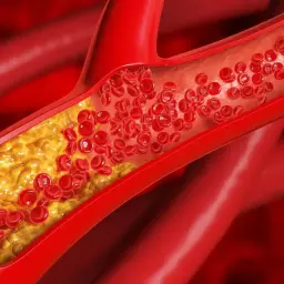 Zator w naczyniu krwionośnym z cholesterolem. Badanie lipoproteiny pomaga ocenić ryzyko chorób serca.