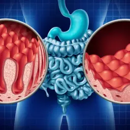 Uszkodzone kosmki jelitowe po spożyciu glutenu, ilustracja porównująca zdrowe i zniszczone jelita. Uczulenie na gluten.