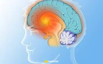 Ilustracja mózgu z zaznaczonymi obszarami, sugerującymi problemy neurologiczne, takie jak pląsawica.