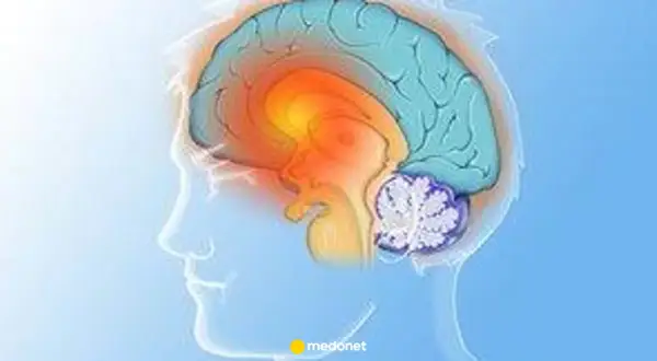 Ilustracja mózgu z zaznaczonymi obszarami, sugerującymi problemy neurologiczne, takie jak pląsawica.