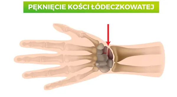 Złamana kość łódeczkowata nadgarstka, zaznaczona czerwoną strzałką.