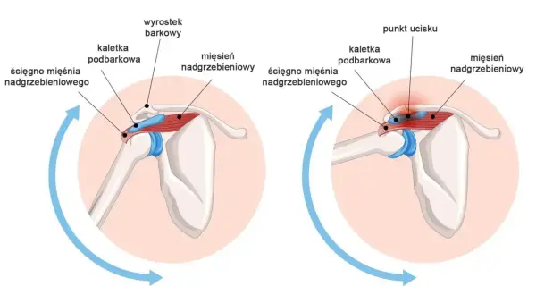 Anatomia barku: prawidłowe położenie ścięgna mięśnia nadgrzebieniowego i kaletki podbarkowej w porównaniu do ucisku i bólu. Obojczyk jest częścią obręczy barkowej.