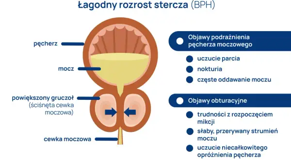 Ilustracja przedstawia łagodny rozrost stercza (BPH), powiększony gruczoł uciskający cewkę moczową, powodując objawy podrażnienia i obturacji.