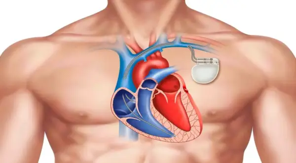 Anatomical illustration of a human chest showing a heart with a rozrusznik serca implanted.