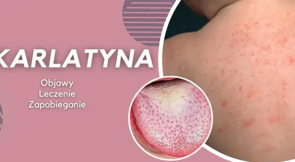 Szkarlatyna: czerwona wysypka na skórze i nalot na języku. Informacje o objawach, leczeniu i zapobieganiu.