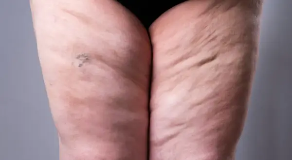 Widoczne uda z widocznymi nierównościami skóry, charakterystycznymi dla lipodemu. Widoczne drobne naczynka.