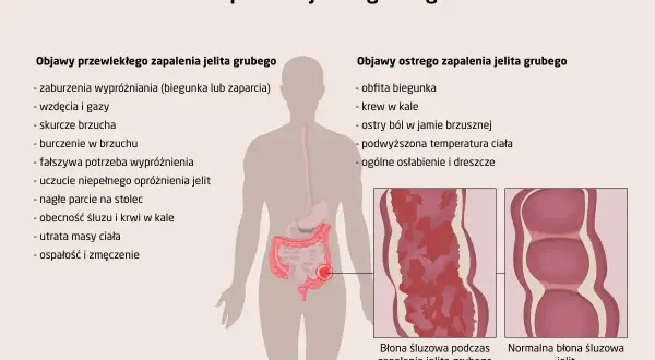Ilustracja przedstawia objawy zapalenia jelita grubego, w tym wrzodziejące zmiany błony śluzowej jelita.