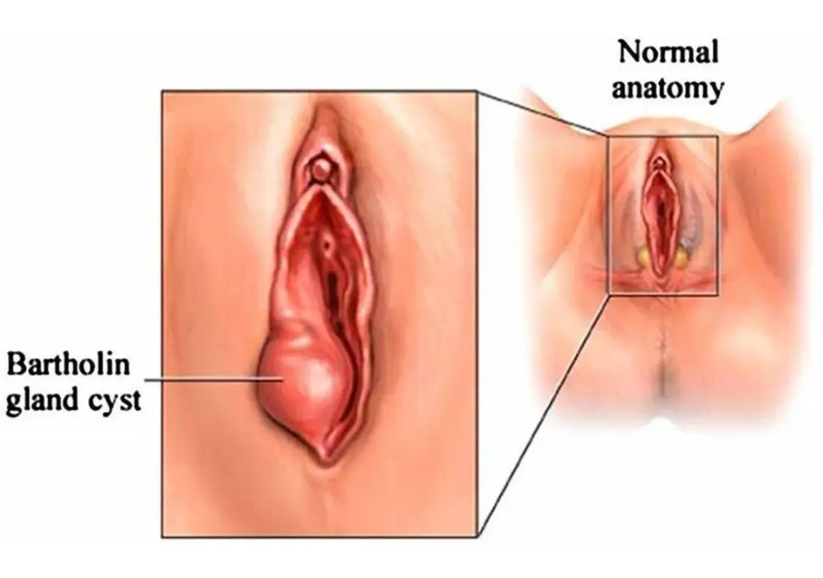 Powiększony gruczoł Bartholina po lewej, po prawej normalna anatomia.