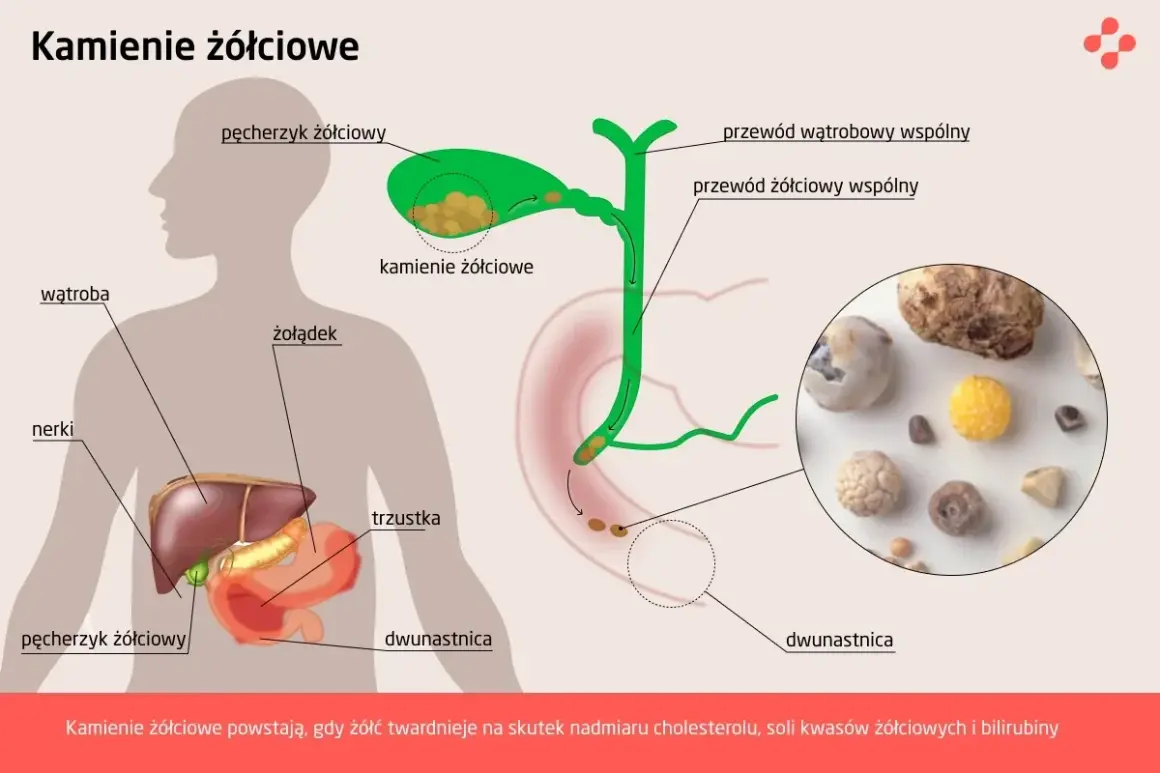 Anatomia człowieka z zaznaczonym pęcherzykiem żółciowym i kamieniami żółciowymi. Obok zdjęcie kamieni.
