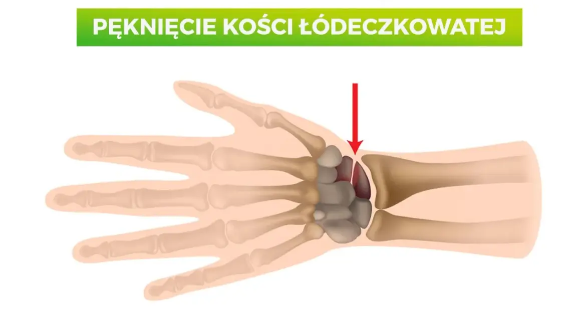 Złamana kość łódeczkowata nadgarstka, zaznaczona czerwoną strzałką.