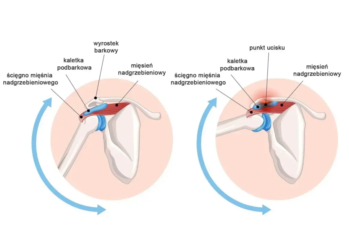 Anatomia barku: prawidłowe położenie ścięgna mięśnia nadgrzebieniowego i kaletki podbarkowej w porównaniu do ucisku i bólu. Obojczyk jest częścią obręczy barkowej.