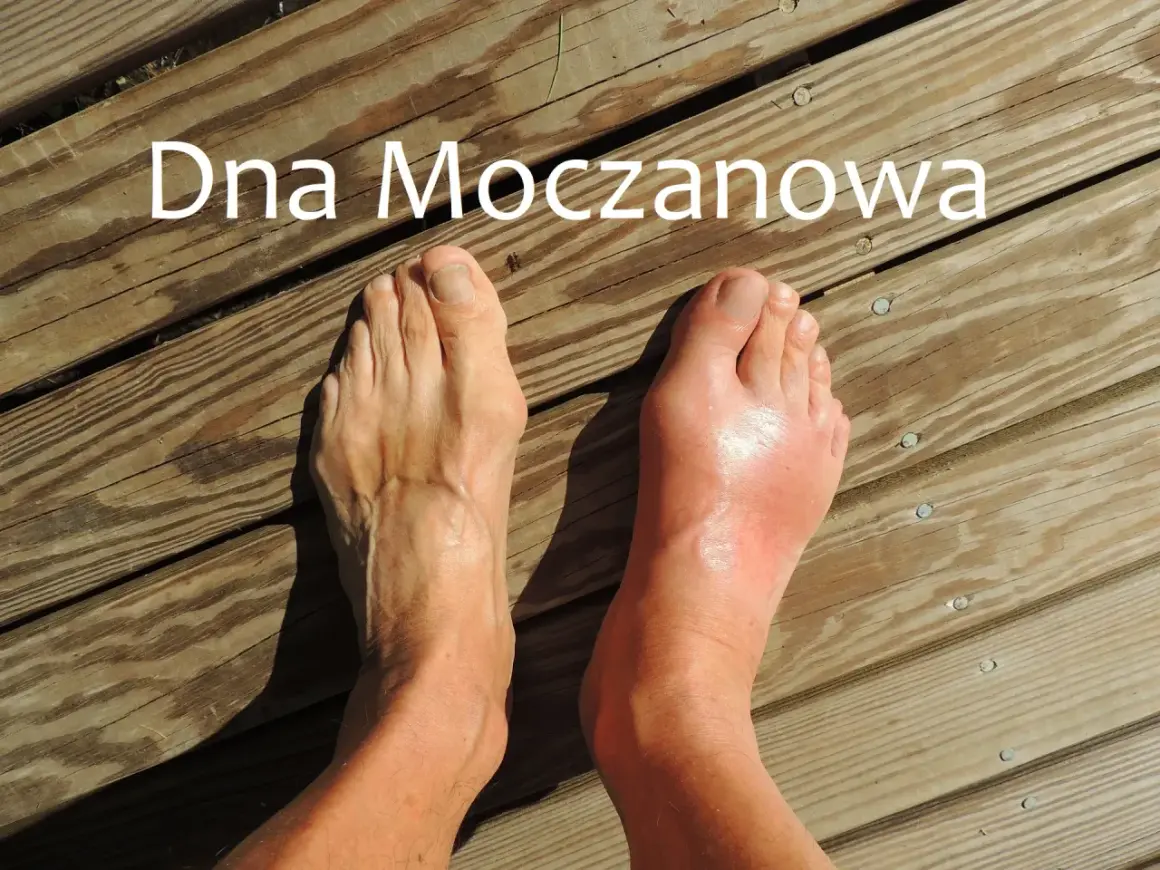 Dna moczanowa - objawy skórne: zaczerwienienie i obrzęk stopy po prawej, zdrowa stopa po lewej.
