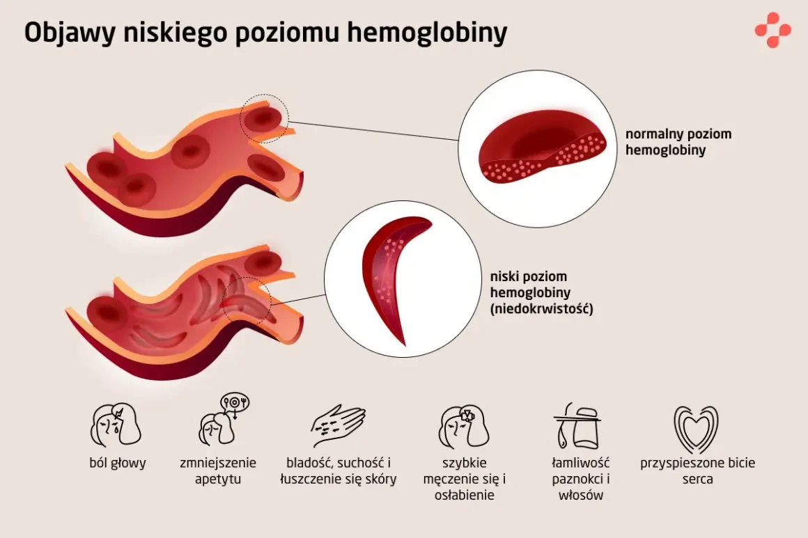 Porównanie krwinek: normalny poziom hemoglobiny vs. niski poziom hemoglobiny (niedokrwistość). Objawy niskiego poziomu hemoglobiny: ból głowy, bladość, zmęczenie.