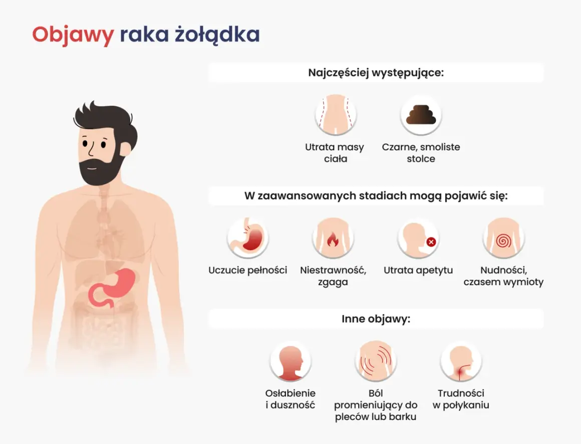 Objawy raka żołądka: utrata masy ciała, czarne stolce, uczucie pełności, niestrawność, zgaga, utrata apetytu, nudności, wymioty, osłabienie, ból pleców, trudności w połykaniu.