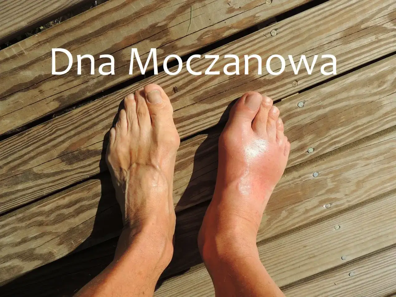Dna moczanowa na skórze. Jak wyglądają tofusy i napad?