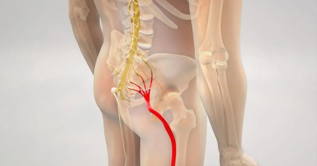 Anatomical illustration showing the sciatic nerve, highlighted in red, originating from the lower spine and extending down the leg.