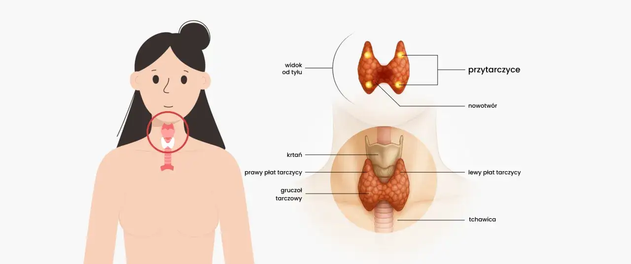 Anatomia szyi z zaznaczonym gruczołem tarczowym i przytarczycami. Obraz przedstawia lokalizację nowotworu i jego związek z parathormonem.