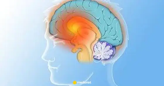 Pląsawica - objawy, przyczyny, leczenie. Kiedy do neurologa?