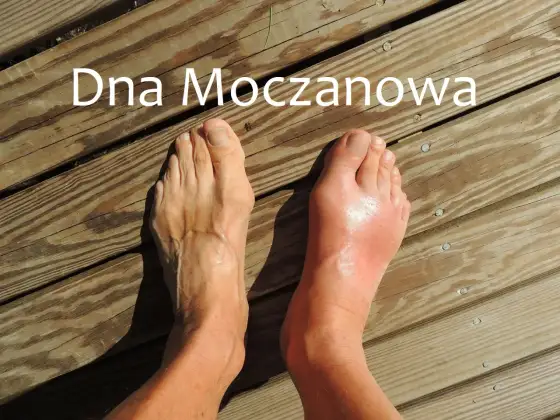 Dna moczanowa na skórze. Jak wyglądają tofusy i napad?