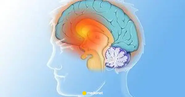 Ilustracja mózgu z zaznaczonymi obszarami, sugerującymi problemy neurologiczne, takie jak pląsawica.