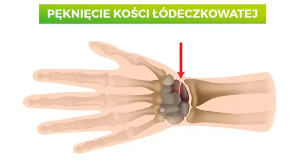 Złamana kość łódeczkowata nadgarstka, zaznaczona czerwoną strzałką.