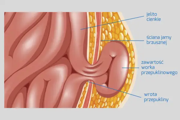 Ilustracja przedstawia jelito cienkie przechodzące przez ścianę jamy brzusznej, tworząc przepuklinę. Widoczne są objawy przepukliny: zawartość worka przepuklinowego i wrota przepukliny.