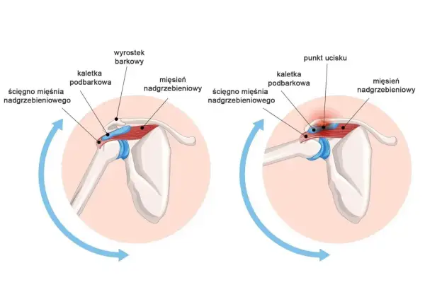 Anatomia barku: prawidłowe położenie ścięgna mięśnia nadgrzebieniowego i kaletki podbarkowej w porównaniu do ucisku i bólu. Obojczyk jest częścią obręczy barkowej.
