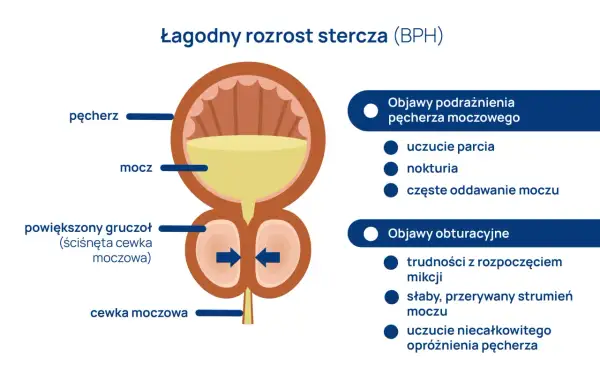 Ilustracja przedstawia łagodny rozrost stercza (BPH), powiększony gruczoł uciskający cewkę moczową, powodując objawy podrażnienia i obturacji.