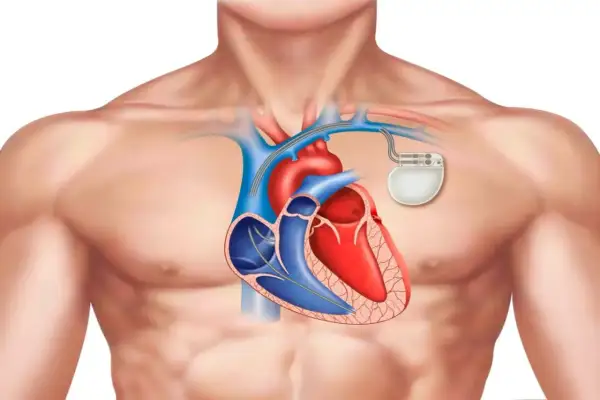 Anatomical illustration of a human chest showing a heart with a rozrusznik serca implanted.
