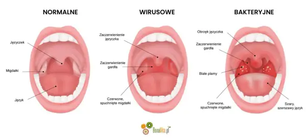 Porównanie gardła: normalne, wirusowe (zaczerwienienie, obrzęk języczka) i bakteryjne (białe plamy, bostonka w gardle).