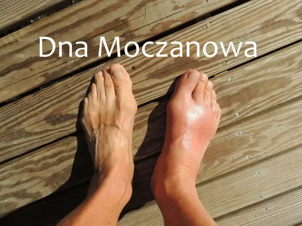 Dwa stopy na drewnianym tarasie. Prawy stopa jest zaczerwieniona i opuchnięta, co sugeruje podagrę.