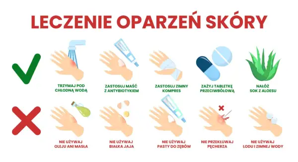 Porady dotyczące leczenia oparzeń skóry: chłodna woda, maść z antybiotykiem, zimny kompres, leki przeciwbólowe, aloes. Unikaj masła, jajka, pasty do zębów, lodu.
